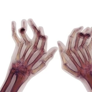 Arthritic hands, X-ray