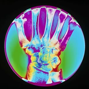Coloured X-ray of bones in the wrist of the hand