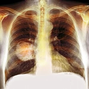 Lung cancer, X-ray C016 / 4432