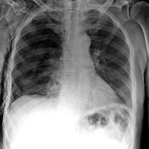 Tension pneumothorax, X-ray